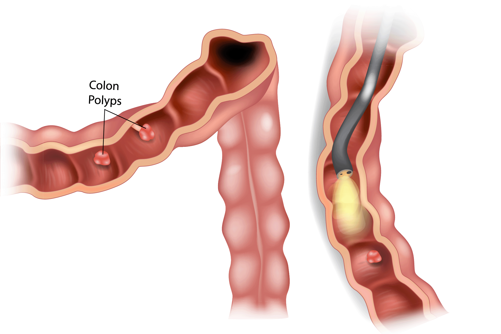 sigmoidoscopy